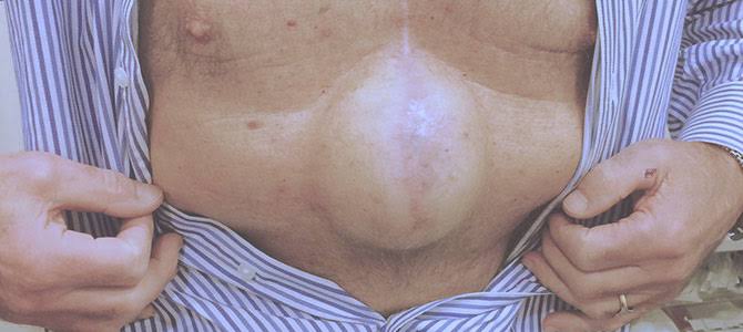 हर्निया (Hernia)